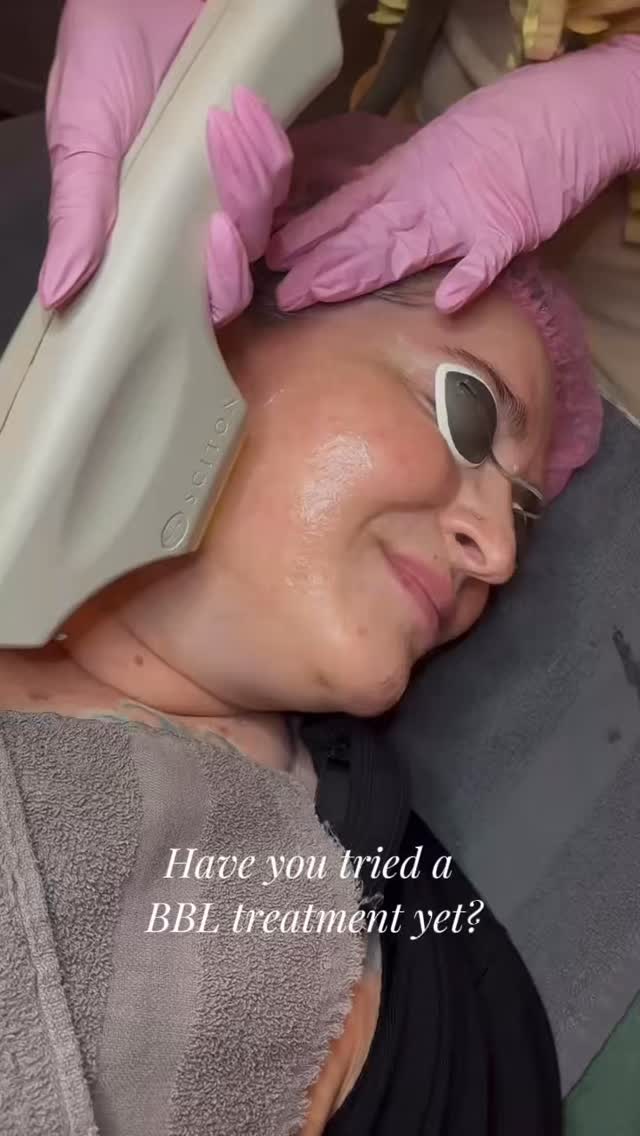 Sun damage, pigmentation, rednessโฆ consider it handled by our BBL Foto Facial โก๏ธ
@sciton_rockymountains
@sciton_inc
#denverfacial #explore #reels #esthetician #denvermedspa