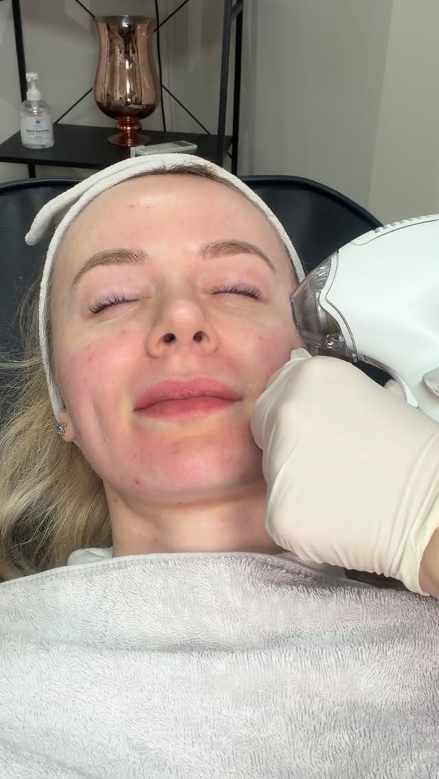 Tixel, a non-laser, thermo-mechanical fractional treatment designed to improve overall skin quality.
Refines texture. Improves clarity. Stimulates collagen where your skin needs it.
Expect redness for up to 24 hours, with light crusting over the following week as the skin renews.
A structured approach to stronger, more resilient skin ✨