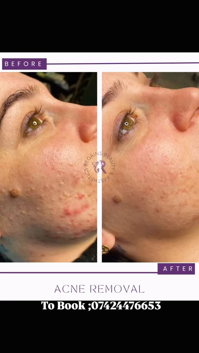 Acne Removal Treatment
📍Milton Keynes Broughton
☎️07424476653
Got it — you want aesthetic, popular acne-related hashtags lined up nicely. Here’s a clean set you can copy/paste:
#acnetreatment #acneremoval #acnecare #clearingskin #acnehelp skincarejourney acnesolutions skinrecovery breakoutfix glowingskin
acnefree clearskinclub skingoals skinconfidence selfcare skincareaddict beautyroutine healthyskin skintransformation glowup
pimplesolution spotremoval oilyskinhelp sensitiveskincare dermatologytips skincareroutine acnepositivity realresults beforeandafter skinhealing