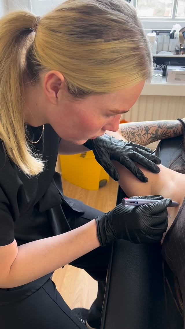 Say goodbye to sweat 💧✨
Underarm Botox works by gently blocking the nerve signals that trigger your sweat glands—meaning less sweating and odour
✔️ Quick treatment (around 10–15 mins)
✔️ Minimal discomfort
✔️ Results in 1–2 weeks
✔️ Keeps you dry for up to 6 months
Perfect for anyone dealing with excessive sweating 💉💫
#UnderarmBotox #AestheticsClinic #aestheticssunderland #aestheticspractitioner