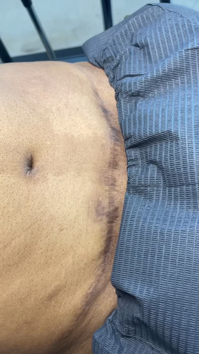 Tummy Tuck Dark Scar Neutralization @beatandblade
We’ve began the initial tattoo session of neutralizing this dark, tummy tuck scar. The goal is to cancel out the hyperpigmentation with ink to mimic her surrounding skin making the scar less visible. Multiple sessions are needed.
If you have a dark, unwanted scar, contact us today! Book a confidential consultation, or schedule an appointment to begin your scar camouflage journey!
This is a medical tattoo.
BEATANDBLADE.COM
#scarcamouflage #medicaltattoo #paramedicaltattoo #tummytuck