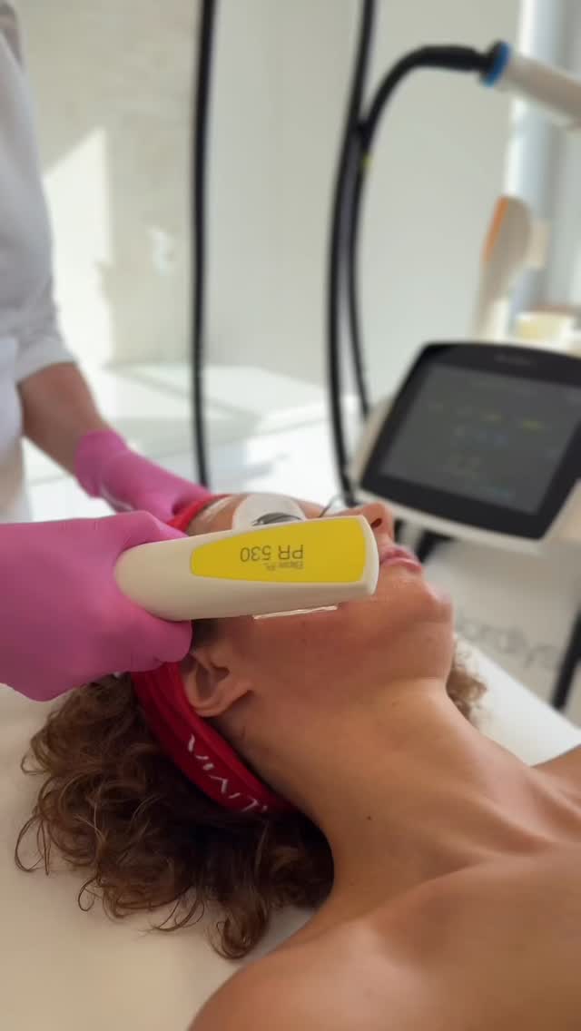 Światło szerokopasmowe✨
Połączenie dwóch technologii w jednym zabiegu daje spektakularne rezultaty. 💫
Głowica PR działa na rumień, naczynka i wyrównanie kolorytu, natomiast VL skupia się na redukcji przebarwień.
Efekt?
✨ Rozświetlona, jednolita cera
✨ Zredukowane zaczerwienienia
✨ Mniej widoczne przebarwienia
✨ Zdrowszy, młodszy wygląd skóry
Technologia Nordlys od Candela pozwala działać wielopoziomowo – szybko, skutecznie i bezpiecznie.💙