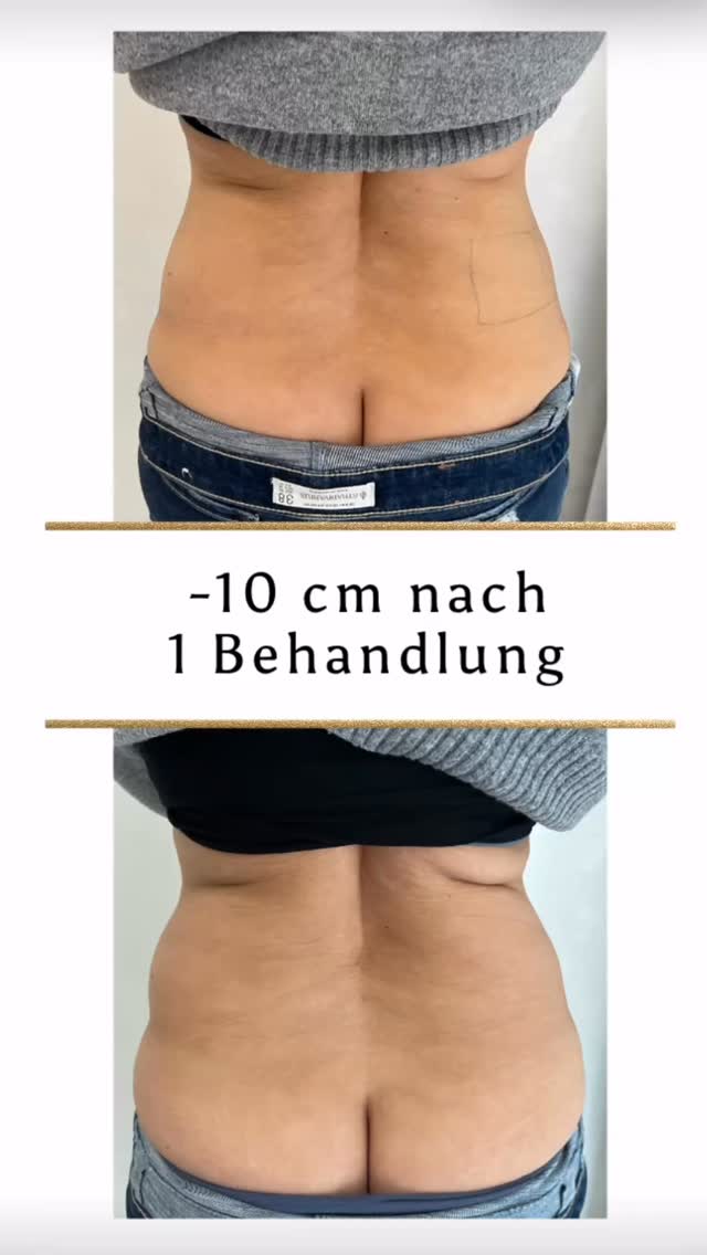 ✨ Fett reduzieren ganz ohne OP? Ja, das ist möglich!‼️✨
Du störst dich an hartnäckigen Fettpolstern an deinen Fesseln und wünschst dir eine schlankere, definiertere Silhouette? 💫
Bei uns kannst du genau das erreichen ohne Schnitte, ohne Ausfallzeit und ohne OP‼️😎
💎 Deine Vorteile auf einen Blick:
✔️ sichtbare Reduktion schon nach nur einer Behandlung möglich
✔️ keine Narben, keine Verletzungen
✔️ kein Tragen von Kompressionskleidung
✔️ direkt zurück in deinen Alltag
✔️ langanhaltende Ergebnisse bei gesunder Lebensweise
Stell dir vor: Du ziehst deine Lieblingsschuhe an und fühlst dich endlich rundum wohl in deinem Körper… 😍
👉 Jetzt ist der perfekte Moment, etwas für dich zu tun.
Warte nicht länger und starte deine Transformation noch heute.
📩 Schreib uns eine DM oder sichere dir direkt deinen Termin – wir beraten dich individuell!
#körperformung #fettreduktion #ohneop #bodygoals #beautytreatments
