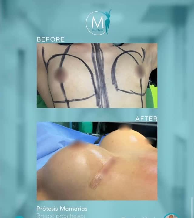 Le changement ne se reflète pas seulement à l’extérieur, mais aussi dans la confiance qui grandit de l’intérieur.
À chaque intervention, nous cherchons à ce que nos patients se sentent plus sûrs d’eux et heureux de leur apparence.
Ce résultat n’est qu’un exemple de la façon dont la chirurgie esthétique peut transformer des vies, toujours avec une approche naturelle et personnalisée.
La beauté est dans les détails et dans la façon dont tu te sens avec toi-même ! ✨
Pour un devis contactez moi sur Facebook Messenger!
#ChirurgiePlastique #ImplantsMammaires #TransformationRéelle #ConfianceEtBeauté #RésultatsInspirants