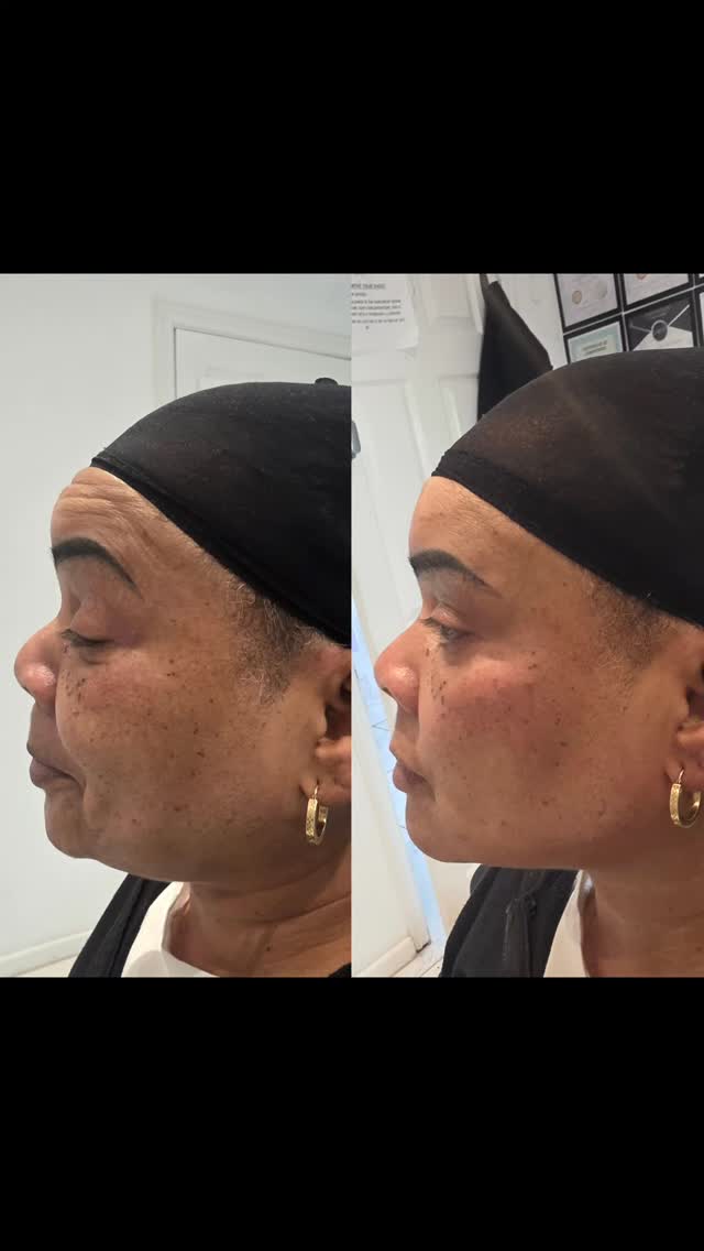 ✨ FULL FACE REBALANCING ✨
Nose • Cheeks • Jaw • Chin
This isn’t about changing your face…
It’s about enhancing what’s already there 🤍
Soft, minimal tweaks to:
💉 Balance your profile
💉 Add gentle structure
💉 Restore harmony to your features
💉 Keep you looking like YOU — just refreshed
No overfilling. No harsh changes.
Just subtle, refined results ✨
Perfect for anyone wanting a natural glow-up without looking “done”
📍 Tailored consultations available
📲 Message to book
#FacialBalancing #NaturalEnhancement #AestheticClinic #SoftEnhancement #ProfileBalancing SubtleTweaks AestheticsUK ChinFiller JawlineContour CheekFiller NoseFiller FreshNotFake
or a luxury high-ticket version 💎