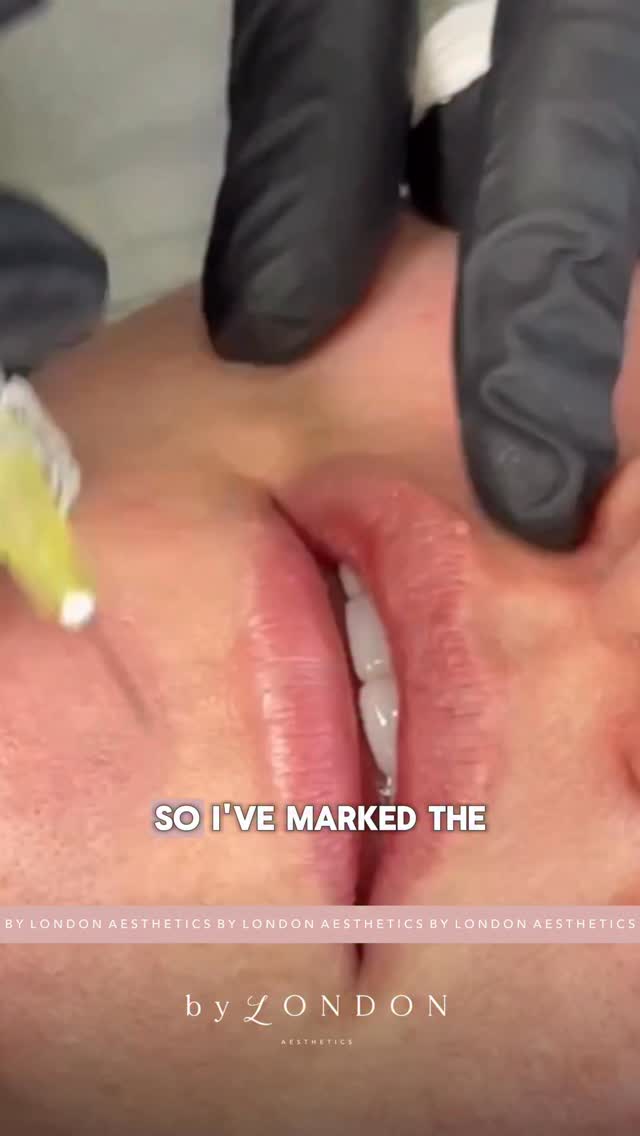 Super natural and discreet Signature Classic Lips ✨
𝗕 𝗬 𝗟 𝗢 𝗡 𝗗 𝗢 𝗡 𝗔 𝗘 𝗦 𝗧 𝗛 𝗘 𝗧 𝗜 𝗖 𝗦
📍 High Road, Wood Green, North London
▪️ Russian Lips
▪️ Full Facial Contouring + Balance
▪️ Liquid Rhinoplasty + Pixie Tip Lift
▪️ Skin Boosters, Polynucleotides + Exosomes
▪️ Anti Wrinkle Advanced
▪️ PDO Threads
📃 𝗖𝗣𝗗 𝗔𝗰𝗰𝗿𝗲𝗱𝗶𝘁𝗲𝗱 𝗧𝗿𝗮𝗶𝗻𝗶𝗻𝗴 𝗳𝗼𝗿 𝗔𝗲𝘀𝘁𝗵𝗲𝘁𝗶𝗰 𝗜𝗻𝗷𝗲𝗰𝘁𝗼𝗿𝘀
👩🏻🎓 Pathway & Beginners Packages
🥇 Advanced Level Masterclasses
💻 Online Courses available
📞 WhatsApp 07774 054 013
#lipfillertraining #fillertraining #dermalfillertraining #fillertraininguk