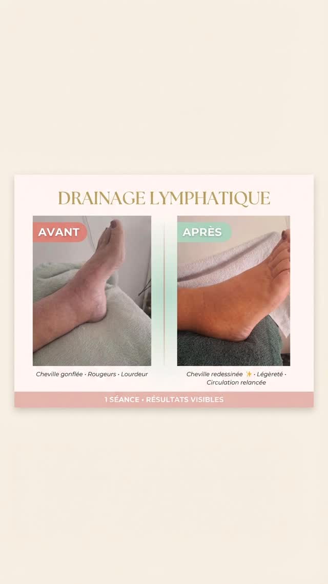 Ma cliente est venue me voir ce matin après un long trajet.
Chevilles gonflées, sensation de lourdeur, inconfort…
Regardez la différence après 1 séance.
Le drainage lymphatique permet de relancer la circulation et de libérer les liquides stagnants.
Résultat : – cheville redessinée
– gonflement diminué
– sensation de légèreté immédiate
Ce soin n’est pas un simple moment de détente.
C’est une technique précise, qui agit en profondeur.
Idéal après : – un voyage
– une station prolongée
– une rétention d’eau