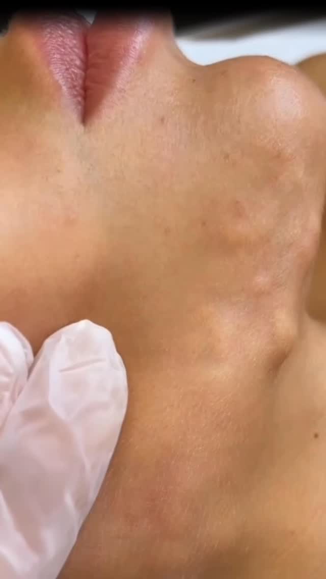 Dolgu sonrası yüzde sarkma olur mu? Cevabı videoda🎬
#dolgu