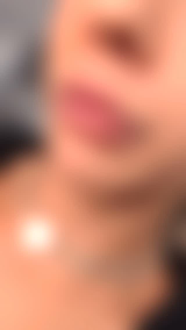 Just had a wonderful session helping a client achieve beautifully balanced lips with filler! 👄 It's so rewarding to see their confidence boost after addressing those uneven areas. We focused on subtle enhancements to create a harmonious and natural look. Seeing the final result always makes my day! ✨ Feeling so grateful for the trust my clients place in me. #lipfiller #lipenhancement #cosmeticfillers #beautytips #bristolaesthetics