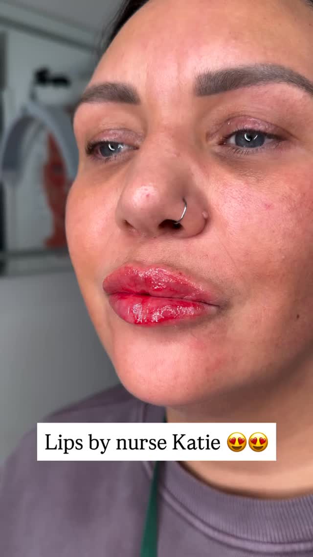 Your perfect lips, just a subtle enhancement away
Lip filler is designed to enhance your natural beauty, giving you soft, balanced, and beautifully defined lips without looking overdone.
✨ Benefits of lip filler:
✔ Adds natural-looking volume
✔ Enhances lip shape and definition
✔ Improves symmetry and balance
✔ Smooths fine lines around the lips
✔ Hydrates and plumps for a softer appearance
The goal is always lips that suit your face perfectly — refined, balanced, and beautifully natural.
📍 Elite Nurse Led Aesthetics – Wakefield
💬 Thinking about lip filler?
Book your consultation today and let’s create your perfect pout 💋
#EliteNurseLedAesthetics
#WakefieldAesthetics
#LipFillerWakefield
#NaturalLipEnhancement
#WakefieldBeautyClinic
