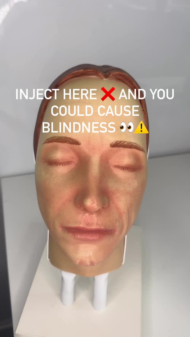 Every injector knows the lips… but this is what separates beginners from advanced practitioners — knowing where NOT to inject.
Follow for more safety tips while you’re injecting!
#aesthetics #safetyinbeauty #medicalaesthetics #aestheticsliverpool #aesthetictraining