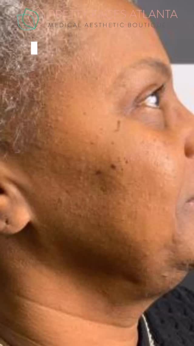 Lifted. Snatched. No surgery needed. ✨
PDO Threads are one of the fastest ways to tighten, lift, and bring your face back to life without downtime. This transformation says everything… instant structure, smoother skin, and natural results that keep improving over time.
If you’ve been catching yourself lifting your face in the mirror… this is your sign 👀
At PFA, we specialize in advanced thread techniques that give REAL results, not overdone looks.
💉 PDO Threads starting at $225 per thread
📍 Pretty Faces Atlanta
📲 Book now at PrettyFacesAtlanta.com
Don’t wait until it drops… lift it now.
#PDOThreads #ThreadLift #PrettyFacesAtlanta #AtlantaAesthetics #SkinTightening