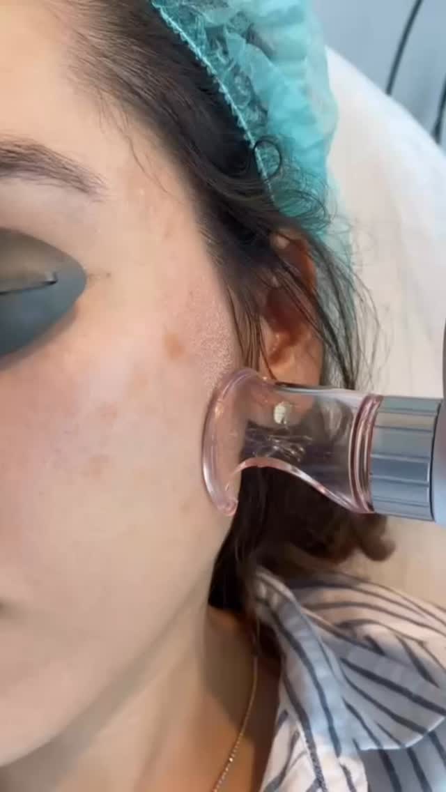 Bir hekim olarak, hastalarıma önerdiğim Q switch fraksiyonel lazer tedavisinin klinik aşamalarını, uygulama anındaki hissi ve sonrasındaki iyileşme sürecini gün gün kaydettim. Cildimin verdiği tepkileri ve iyileşme hızını merak edenler için bu videoda tüm süreci adım adım paylaşıyorum.
DM den LAZER yazarsan işlem sonrasını rutinimi paylaşabilirim 🫶🏼