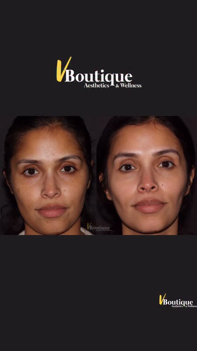 ✨ Look at that GLOW ✨
This patient came in with concerns of melasma, hyperpigmentation, and uneven skin tone—and we treated her using one of the most advanced laser systems in the world: the Fotona StarWalker 💎 the BEST for treating pigment—in ALL skin types.
Unlike basic lasers you might find at a typical medspa, the StarWalker combines:
⚡ Pico technology – shatters pigment into ultra-fine particles for faster, safer clearance
🌊 Multiple wavelengths – allows us to target different depths and types of pigment
🔥 Advanced pulse modes to stimulate collagen while improving skin texture and tone
What does this mean for YOU?
➡️ We can customize treatments with incredible precision
➡️ Treat stubborn melasma safely
➡️ Improve overall skin quality, not just pigment
And the best part?
✨ Minimal downtime (fully adjustable depending on your goals)
✨ Virtually pain free with topical numbing
Just look at her results…
💫 Brighter
💫 Smoother
💫 Even-toned
💫 And a subtle tightening in the jawline & cheeks from collagen stimulation
And NO—this was laser only.
No fillers. Just technology + expertise.
She is absolutely thrilled—and honestly, so am I 🤍
—
#SkinTransformation #LaserExpert #MelasmaTreatment #HyperpigmentationSolution #FotonaStarWalker