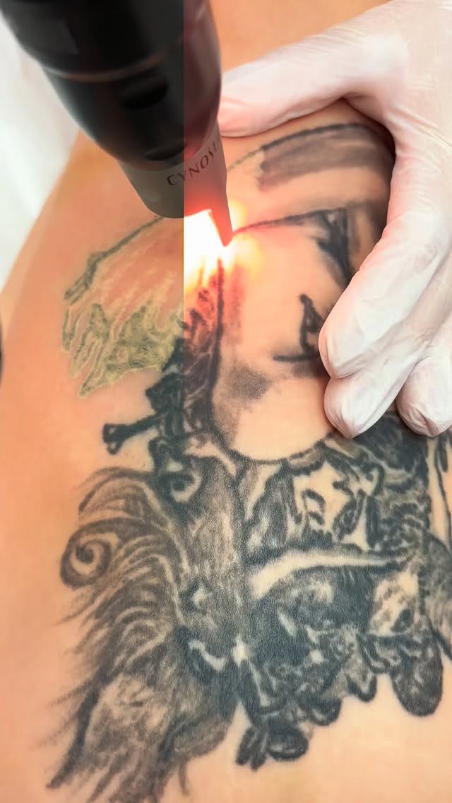 𝐋𝐚𝐫𝐠𝐞 𝐓𝐚𝐭𝐭𝐨𝐨 𝐑𝐞𝐦𝐨𝐯𝐚𝐥… 𝐈𝐭’𝐬 𝐚 𝐏𝐫𝐨𝐜𝐞𝐬𝐬 — 𝐍𝐨𝐭 𝐀 𝐐𝐮𝐢𝐜𝐤 𝐅𝐢𝐱 🖤
Removing large tattoos isn’t about one session… it’s about precision, strategy, and skin health over time.
At Trust Beauty Bar, we specialize in treating large, multi-layered tattoos using advanced technology designed to break down ink safely and effectively.
𝐖𝐡𝐲 𝐝𝐨 𝐥𝐚𝐫𝐠𝐞 𝐭𝐚𝐭𝐭𝐨𝐨𝐬 𝐭𝐚𝐤𝐞 𝐥𝐨𝐧𝐠𝐞𝐫?
✨ Multiple ink layers + deeper pigment placement
✨ Different ink colors respond at different speeds
✨ Larger surface area = staged clearance approach
✨ Your lymphatic system needs time to flush fragmented ink
𝐎𝐮𝐫 𝐀𝐩𝐩𝐫𝐨𝐚𝐜𝐡 𝐀𝐭 𝐓𝐫𝐮𝐬𝐭 💎
We don’t just “laser and hope for the best”… we treat this clinically.
✔️ PicoSure Pro Technology
Ultra-short picosecond pulses shatter ink into microscopic particles for faster clearance and less damage to surrounding tissue
✔️ Customized Treatment Mapping
We strategically divide large tattoos into sections to optimize healing + results
✔️ Skin Preservation First
Minimizing risk of scarring, hypopigmentation, and over-treatment
✔️ Lymphatic + Healing Support
We guide your body to properly eliminate ink through post-care protocols
𝐑𝐞𝐚𝐥𝐢𝐭𝐲 𝐂𝐡𝐞𝐜𝐤 👇
Large tattoo removal can take multiple sessions over several months to years — but done correctly, the results are clean, safe, and worth it.
This is where technology + expertise + patience come together.
𝐓𝐡𝐢𝐧𝐤𝐢𝐧𝐠 𝐨𝐟 𝐫𝐞𝐦𝐨𝐯𝐢𝐧𝐠 𝐚 𝐥𝐚𝐫𝐠𝐞 𝐩𝐢𝐞𝐜𝐞?
Let’s build a plan that protects your skin while delivering results. 🖤
📍 Vaughan, ON
🔗 Book your consultation at trustbeautybar.ca
⸻
#tattooremoval #picosurepro #tattoo