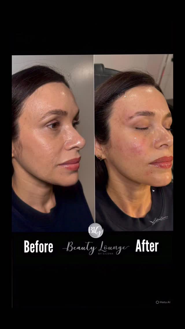 ✨ Si te ves cansada… esto es lo que necesitas:
💉 Botox
💋 Filler
💧 Vitamin IV
Todo en 1 visita = Refresh total en puntos clave de la cara.Y cuando lo haces bien, pasa esto 👇
✨ Te ves más joven
✨ Más descansada
✨ Más bonita SIN verte exagerada
🔥 Promo SOLO este mes
🎁 Cupos limitados
📲 Escribe “REFRESH”📲 Comenta “QUIERO”