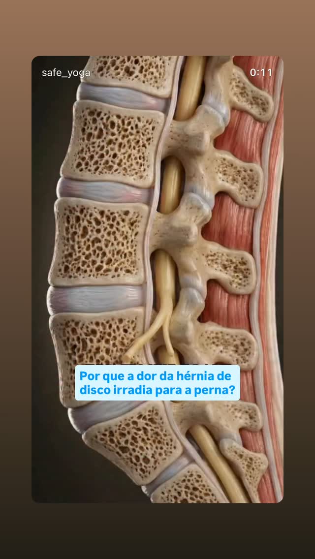 Excelente animação, que demonstra com muita exatidão o motivo de uma hérnia de disco na coluna lombar causar dor que “corre” pela perna - a famosa dor do nervo ciático.
As raízes nervosas que irão formar o nervo ciático se originam da coluna vertebral.
Quando ocorre a hérnia discal, o disco apresenta uma ruptura do seu anel externo (ânulo fibroso), o material interno do disco (núcleo pulposo) extrui por esta ruptura e comprime a raiz nervosa que encontra-se adjacente ao disco.
Logo, como o nervo ciático encontra-se comprimido na sua “origem”, o estímulo doloroso irá irradiar pelo trajeto do nervo ciático ao longo do membro inferior.
Assim, o paciente pode referir dor em qualquer uma das partes deste trajeto (lombar baixa, glúteo, posterior da coxa, panturrilha, pé) , ou até mesmo em todas as partes.
Vale lembrar que, comumente, a dor associa-se a outros sintomas, como formigamento, amortecimento, diminuição de força, sensação de choque etc
#ortopedia #colunavertebral #dor #medicina #cirurgiadacoluna
Créditos @safe_yoga
