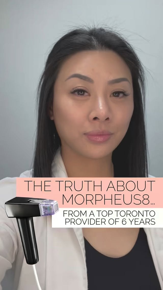 Morpheus8 is everywhere right now… and so are the opinions about it.
But after 6 years of using it almost every day, our Lead Medical Aesthetician Anne has a pretty clear perspective on what’s real and what’s not.
We were one of the first providers in the GTA to bring Morpheus8 to patients, and we continue to offer the full range of treatments:
✨ Morpheus8
✨ Morpheus8 Body
✨ Morpheus8 Eye
In this video, Anne breaks down why the treatment sometimes gets a bad reputation — and what actually determines whether results are amazing or disappointing.
Spoiler: technique, experience, and patient selection matter.
#Morpheus8Treatment #AestheticExpert #RFMicroneedling #SkinTightening #MedicalAesthetics