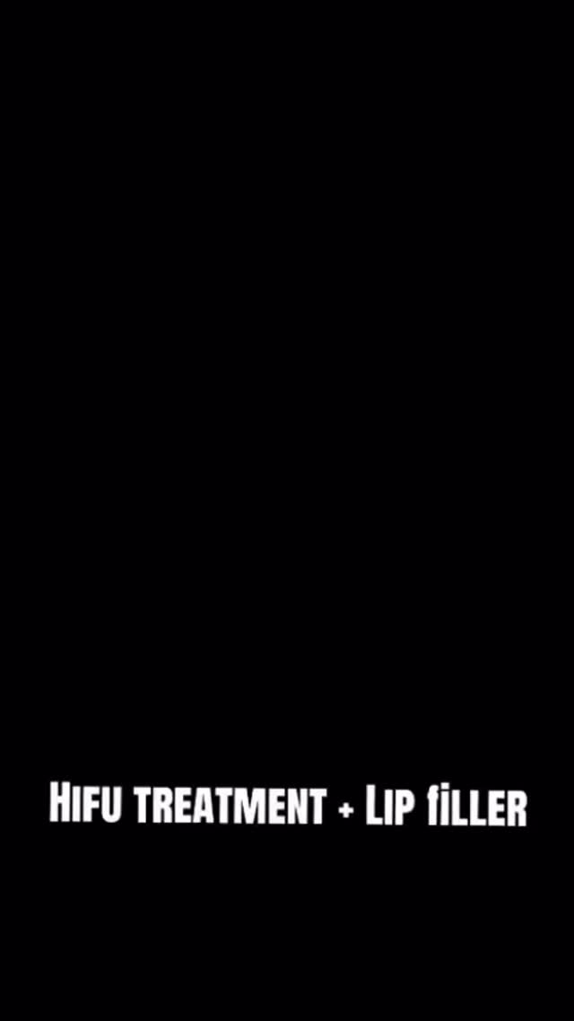 ✨ Glow up season ✨
HIFU treatment + lip enhancement and I’m OBSESSED with the results 😍
Skin feeling tighter, lifted, and super fresh 💫
Lips looking fuller but still natural 💋
The perfect combo for that snatched + hydrated look!
Can’t wait to see the full results over the next few weeks 🤍
#HIFU #LipFiller #AestheticJourney #GlowingSkin #SelfCare ConfidenceBoost