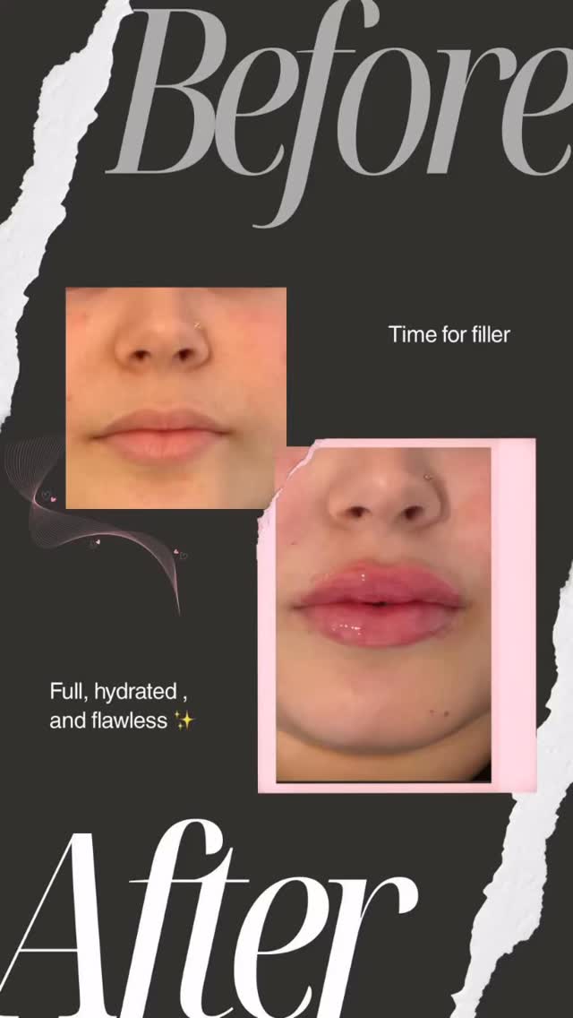 A little volume, a lot of confidence 💫 #LipFiller #AestheticResults”