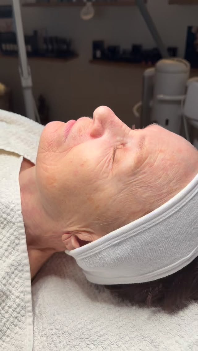 #krefeld#microdermabrasion#needling#aparativekosmetik#soforteffekt