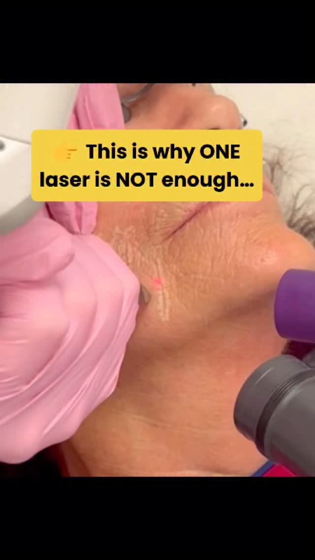 ✨ Not all lasers are created equal… and neither is your skin ✨
This is a perfect example of why customization matters 👇
For my beautiful patient who was bothered by vertical lip lines (“smoker’s lines”) and facial redness, we created a 3-step laser plan in ONE session:
1️⃣ Gentle full-field resurfacing to soften and smooth those stubborn lip lines
2️⃣ Nd:YAG laser to precisely eliminate broken capillaries & spider veins
3️⃣ Fractional resurfacing for overall tightening, texture, tone, and glow
💡 By combining different wavelengths and devices safely, we’re able to target multiple concerns at once—something that takes years of training and experience to do correctly.
✨ We also enhanced healing and results with topical exosomes + medical-grade skincare
⏳ Expect ~3–7 days of redness/peeling… but the transformation is SO worth it
This is what 20+ years of laser experience allows me to do:
➡️ personalize
➡️ combine
➡️ optimize results safely
No cookie-cutter treatments here 💫
#LaserSkinResurfacing #NdYAGLaser #SkinRejuvenation #AestheticMedicine #CustomSkincare