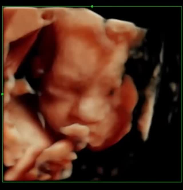 Catching their first wave 👋🏼
There’s nothing more special than seeing your baby’s personality shine through before they’re even here🤍
Moments like this are why we do what we do…those little movements, tiny waves, and unforgettable memories you’ll treasure forever✨
💫 Available scans:
Early scans from 8 weeks
Gender scans from 16 weeks
4D bonding experiences
📍 Visit our Nelson clinic
💻 Book your scan via our website
We promise… you’ll never forget moments like this 🥹🤍
#BabyScanUK #PrivateUltrasound #4DScan #PregnancyJourney #BabyOnTheWay