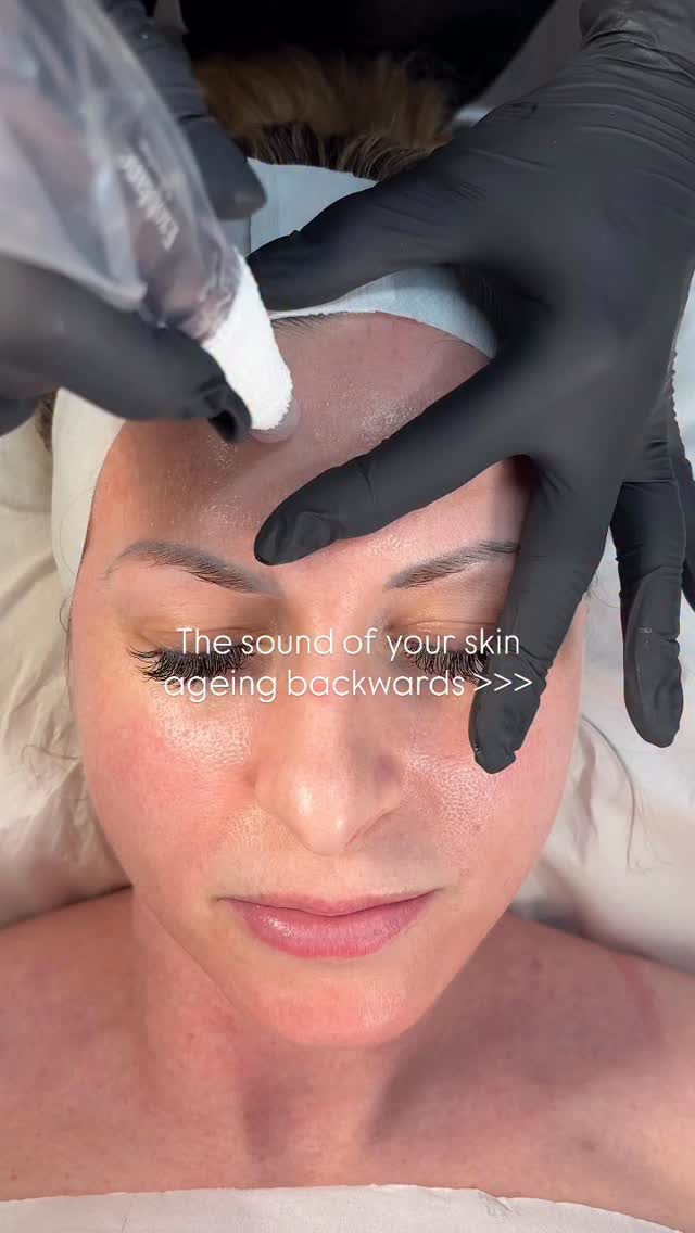 Not ready for *tox but want to age backwards?? Try microneedling 🙌🏽
Did you know, one session of microneedling produces the same amount of collagen that you’ve lost in the past year 😮
We use a range of different serums that we infuse during the treatment, depending on your skin concerns to ensure you get the best possible results!