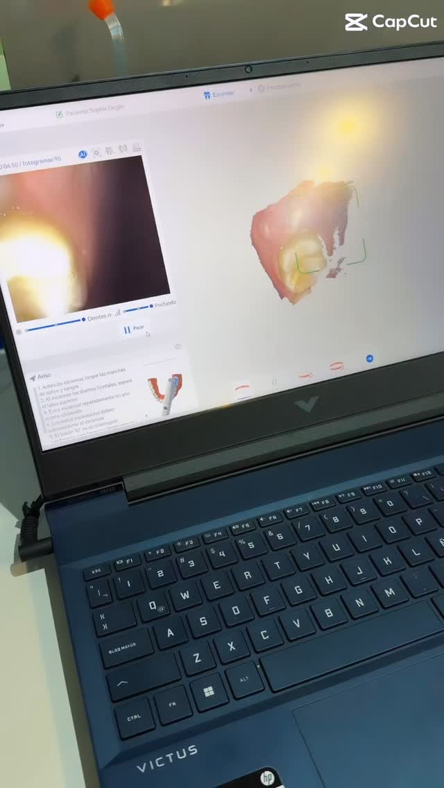 ✨ El primer paso para tu nueva sonrisa comienza aquí ✨
🦷 Escaneo intraoral 3D: capturamos tu sonrisa con máxima precisión y en pocos minutos ✨
🦷 Tu sonrisa en versión digital 🦷📲
Tecnología 3D rápida, cómoda y exacta
🦷 Así vemos tu sonrisa por dentro 👀
Escaneo oral 3D para un diagnóstico preciso y personalizado
✨ Con esto comenzamos el proceso de tus alineadores 😄
📍 7 Norte 645, Of. 514 – Viña del Mar
📲 Agenda tu evaluación: +56 9 9497 9558. #ortodoncia #alineadoresinvisibles #alineadoresdentales #alineadoresinvisalign #invisalign