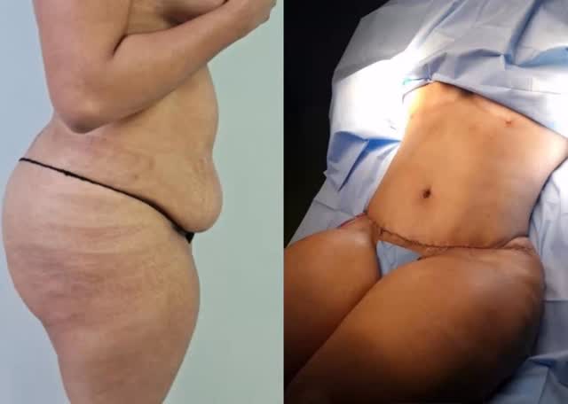 ✨ Transformation réelle LIPOSCULPTURE & ABDOMINOPLASTIE ✨
Résultat signé par le talentueux et professionnel Dr. Manuel Marte-Plastic Surgeon, à Santo Domingo 🇩🇴
Une silhouette redessinée, un ventre raffermi, une confiance retrouvée 💫
Tu veux savoir si tu es candidate et recevoir ton devis personnalisé ?
Écris-moi directement sur Facebook Messenger, je m’occupe de toi du début à la fin 💙
#chirurgie #chirurgieesthetique #aandbeautyinternational #accompagnementvip
http://Aandbeautyinternational.com
#chirurgieesthetique