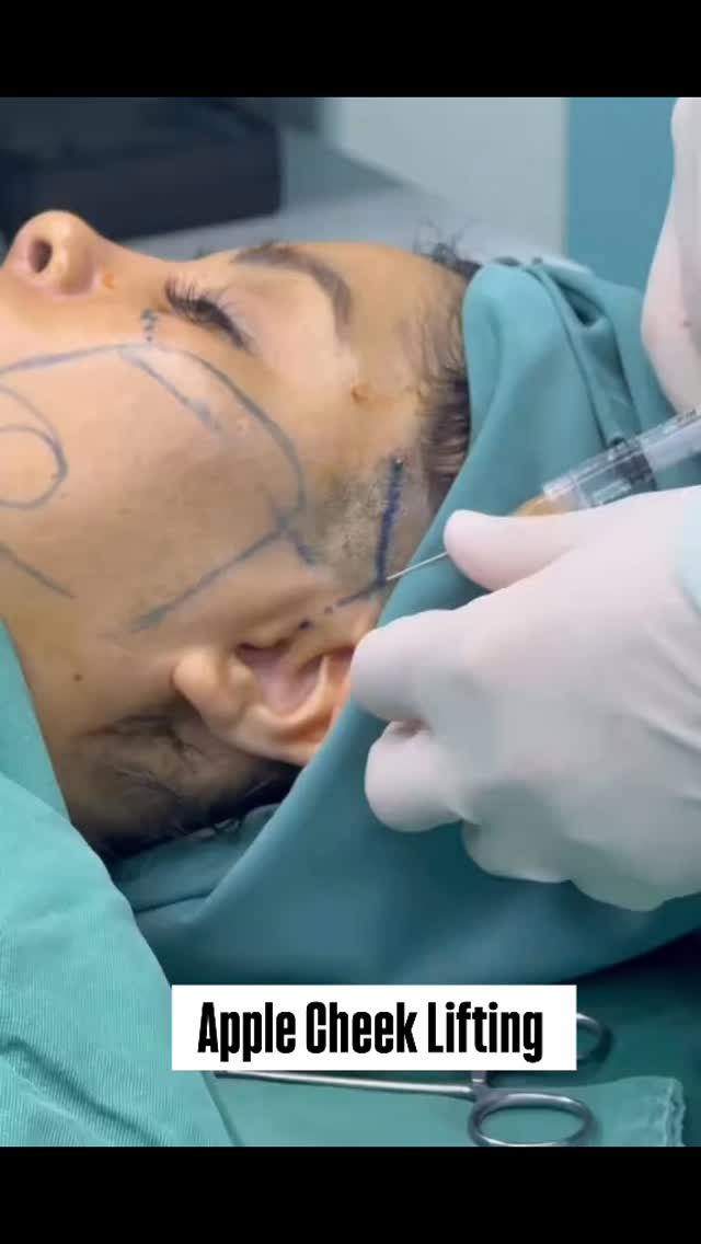Apple cheek lifting .
No downtime
R&R Beauty Clinic
VietNam Plastic Surgery
#medicaltourism #plasticsurgery #fatremoval #rrbeauty #liftingface