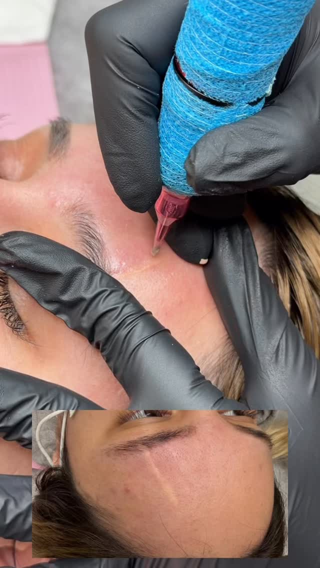 SCAR CORRECTION!…. Whether it’s a facelift, an accident or any kind of surgery …. I MAKE YOUR SCARS LOOK SUBTLE and camouflaged…
Got questions? DM me or comment below 👇🏻
#elpasoscarcamoflauge #elpasofacelift #scarcamo