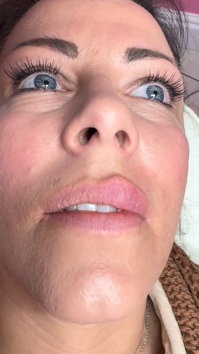 Restoring balance, hydration & shape 🫶🏼🩷 #aestheticsderby #aestheticsnottingham #lipfillerderby #lipfiller #aestheticsleicester