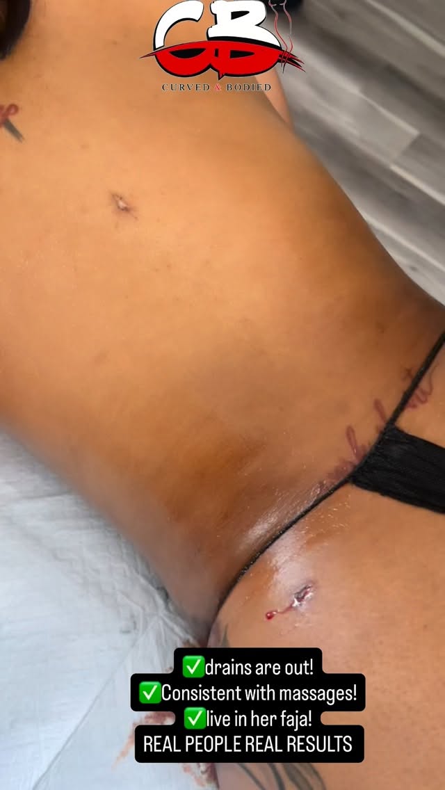 POST-OP MASSAGES IS NOT A OPTION ITS ESSENTIAL!
* Don’t play about your aftercare 😌
* You paid for that body… take care of it! 💅🏽
* Surgery is step 1… I’m step 2 💯
* No massage = no results 👀
* Get snatched the RIGHT way 🔥
DM OR TEXT 📲(346)857-3714
#viral #postopcare #goviral #postopcarehouston #viralvideos