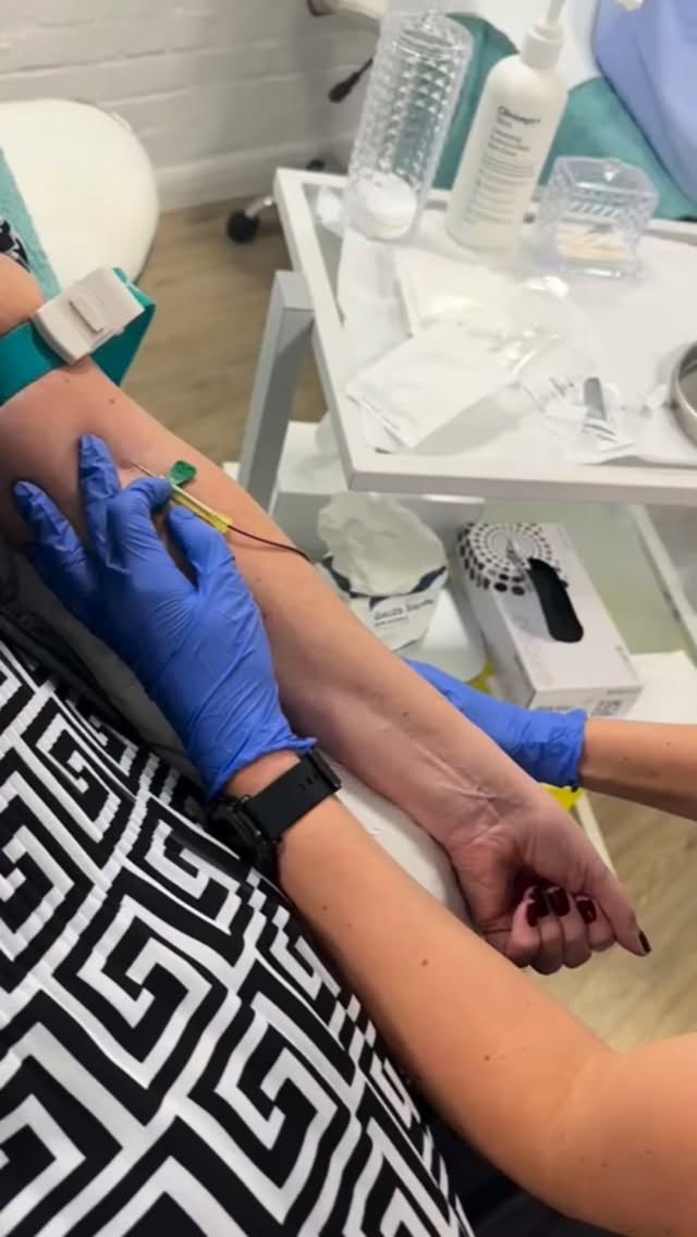 ✨ PLASMA BIO GEL TRAINING ✨
The future of natural filler is here.
Learn how to create your own autologous plasma gel using your client’s blood — a completely natural alternative to traditional dermal fillers.
💉 No synthetic product
🧬 Bio-stimulating + regenerative
✨ Subtle, natural-looking volume
🩸 Uses your client’s own plasma
This is next-level aesthetics — perfect for clients who want results without traditional filler.
On this advanced training, you’ll learn:
✔️ Blood collection & processing
✔️ Plasma gel preparation protocols
✔️ Injection techniques & placement
✔️ Indications + treatment planning
✔️ Safety, contraindications & aftercare
Elevate your clinic with one of the most in-demand regenerative treatments.
📍 Limited spaces available
📩 DM “PLASMA” to secure your place
#PlasmaBioGel #NaturalFiller #AestheticTraining #RegenerativeAesthetics #SkinRejuvenation
:::