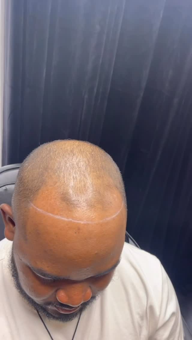 Scalp Micropigmentation can be the solution to your receding hairline, thinning, balding, alopecia or hair loss!
Contact us today for an affordable alternative to a hair transplant that last for several years! Book a consultation or send us pictures so that we can help in your journey of restoration and renewed confidence.
BEATANDBLADE.COM
#smp #scalpmicropigmentation #hairloss #beforeandafter #transformation