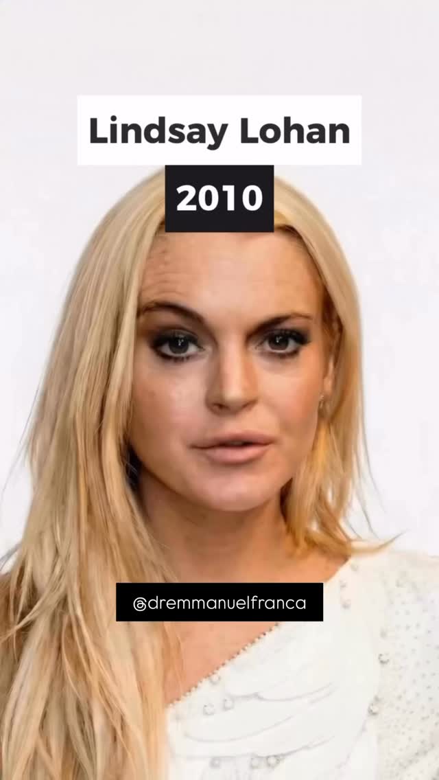 O que muita gente chama de “genética boa”… muitas vezes é dermatologia bem feita.
A evolução de alguns artistas ao longo dos anos mostra que envelhecer bem não é sobre mudar o rosto — é sobre acompanhar o tempo com estratégia.
Hoje, com tecnologias avançadas, injetáveis bem indicados e cuidados contínuos, é possível preservar a naturalidade, melhorar a qualidade da pele e manter a harmonia facial.
Não é sobre parecer outra pessoa.
É sobre continuar sendo você — em sua melhor versão.
Dr Emmanuel França
Dermatologista
CRM 5999
RQE 636
📍Skin Prime - Riomar Trade Center - Torre 3 - Sala 1905
☎️ (81) 3036-4040