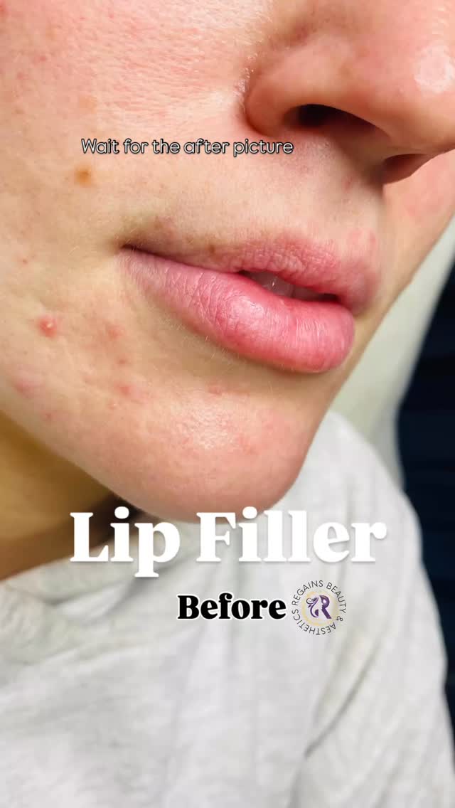 Natural, but better 💋
#lip #lipdissolve #lipfillers #naturallip #trendyreels