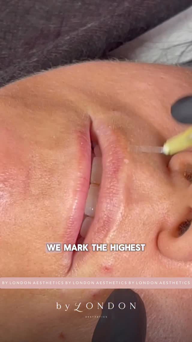 Worried you’re not ‘ready’ for Russian lips? You might not grasp the technique as quickly as others?
I hear this all the time from injectors. You don’t want to rush into something you’re not confident with, but you also don’t want to stay stuck doing the same classic techniques forever
That’s exactly why my training is tailored. Yes, I have two tiered Russian lip training for beginners and advanced practitioners, but everyone comes in at a different level, so I adjust how I teach, every single course. How I demonstrate, and how much support & how far we can push on the day
There is no pressure on you whatsoever. The only pressure I apply is on my plunger and 𝘮𝘺𝘴𝘦𝘭𝘧 ….to make sure you leave my studio 𝘤𝘰𝘯𝘧𝘪𝘥𝘦𝘯𝘵 enough to go back into clinic and use what you’ve learnt
If you’ve been putting it off because you’re not sure you’re ready, this is your 🪧
𝗕 𝗬 𝗟 𝗢 𝗡 𝗗 𝗢 𝗡 𝗔 𝗘 𝗦 𝗧 𝗛 𝗘 𝗧 𝗜 𝗖 𝗦
📍 High Road, Wood Green, North London
▪️ Russian Lips
▪️ Full Facial Contouring + Balance
▪️ Liquid Rhinoplasty + Pixie Tip Lift
▪️ Skin Boosters, Polynucleotides + Exosomes
▪️ Anti Wrinkle Advanced
▪️ PDO Threads
📃 𝗖𝗣𝗗 𝗔𝗰𝗰𝗿𝗲𝗱𝗶𝘁𝗲𝗱 𝗧𝗿𝗮𝗶𝗻𝗶𝗻𝗴 𝗳𝗼𝗿 𝗔𝗲𝘀𝘁𝗵𝗲𝘁𝗶𝗰 𝗜𝗻𝗷𝗲𝗰𝘁𝗼𝗿𝘀
👩🏻🎓 Pathway & Beginners Packages
🥇 Advanced Level Masterclasses
💻 Online Courses available
📞 WhatsApp 07774 054 013
#lipfillertraining #russianliptraininguk #russianliptraining #fillertraining #fillertraininglondon