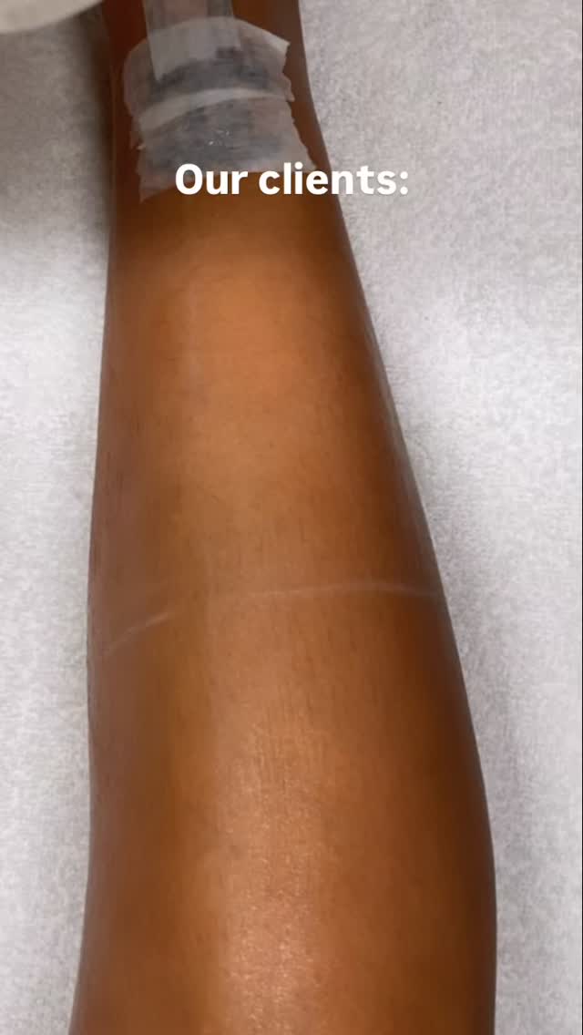 If you know you know🥶🥶🥶🥶
#laserhairremoval #amsterdam #funny
