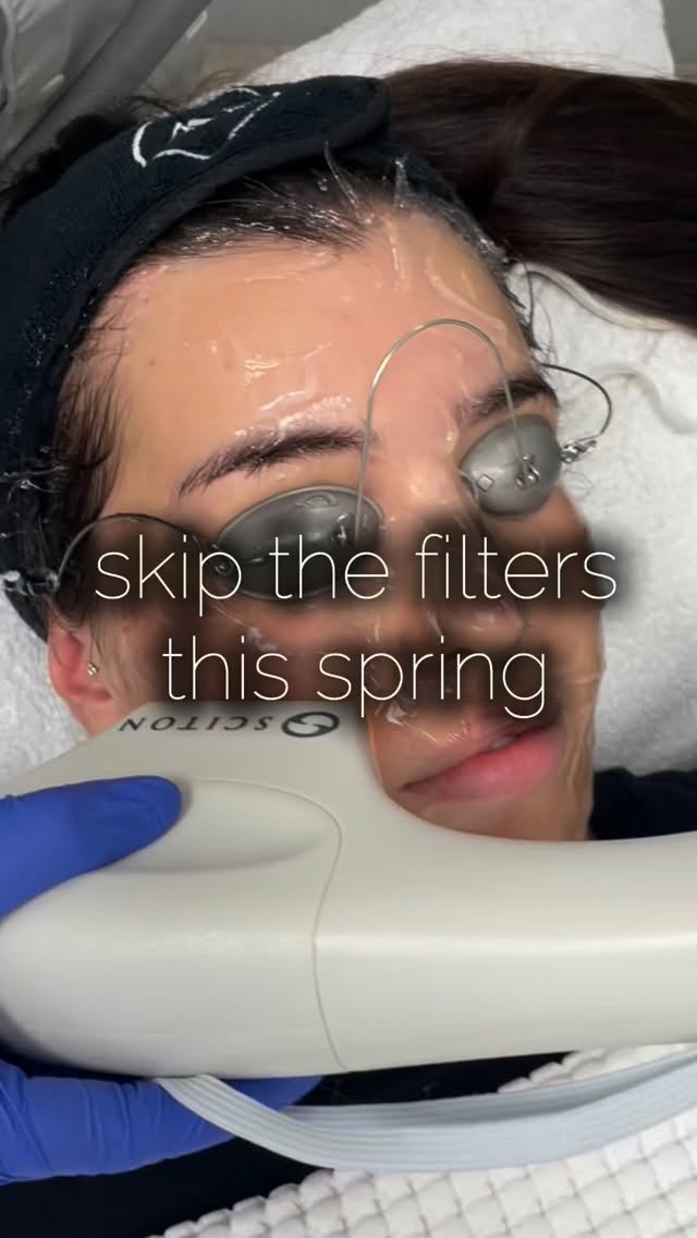 This is more than a filter—it’s the real thing. ✨
Our treatment works beneath the surface to smooth texture, refine pores, boost hydration, and give your skin that naturally radiant, glass-like finish… no editing required.
Perfect for you if you:
• Feel like your skin looks dull or uneven
• Rely on filters to blur texture or pores
• Want a fresh, glowing look without makeup
• Are ready for results that actually last
Because when your skin looks this good in real life… you won’t need a filter anymore.
#SkinConfidence #NoFilterSkin #GlowingSkin #SkinTreatment #RealResults