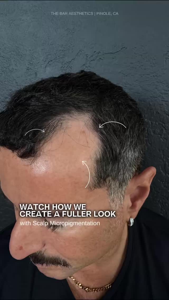 What you’re seeing isn’t new hair. It’s actually a natural-looking tattoo 🔎
Scalp Micropigmentation places tiny impressions that replicate natural follicles, helping reduce the contrast between scalp and hair.
It’s one of the most low-maintenance solutions for hair loss without surgery or downtime.
Have you heard of SMP before, or is this your first time learning about it?
LINK IN BIO to learn more and to schedule your sessions!
📍Pinole, CA
#scalpmicropigmentation #hairlinerepair #hairlosssolutions #smpartist #bayareasmp