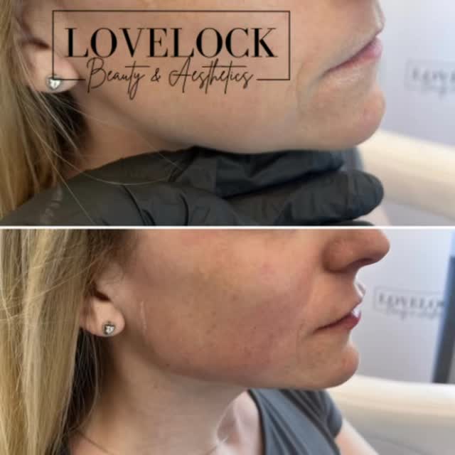 Jawline Sculpting
🏆 NBA WINNER Best facial sculpting 2026 🏆
📕 Level 7 Expert Practitioner.
A sculpted jawline can completely transform facial balance and definition ✨
Jawline contouring with dermal filler is a non-surgical treatment designed to enhance structure, improve symmetry, and restore lost definition along the lower face.
✨ Benefits of jawline sculpting:
• Creates a sharper, more defined profile
• Enhances facial proportions and harmony
• Supports jowls and softens lower-face heaviness
• Can subtly lift the lower face
• Immediate, natural-looking results
• Minimal downtime
Perfect for anyone wanting a more contoured, youthful appearance without surgery.
Results are tailored to your unique facial anatomy for a refined, not “overdone” finish.
📍Book your consultation today to see if jawline sculpting is right for you.
#trowbridge #westbury #warminster #melksham #bradfordonavon