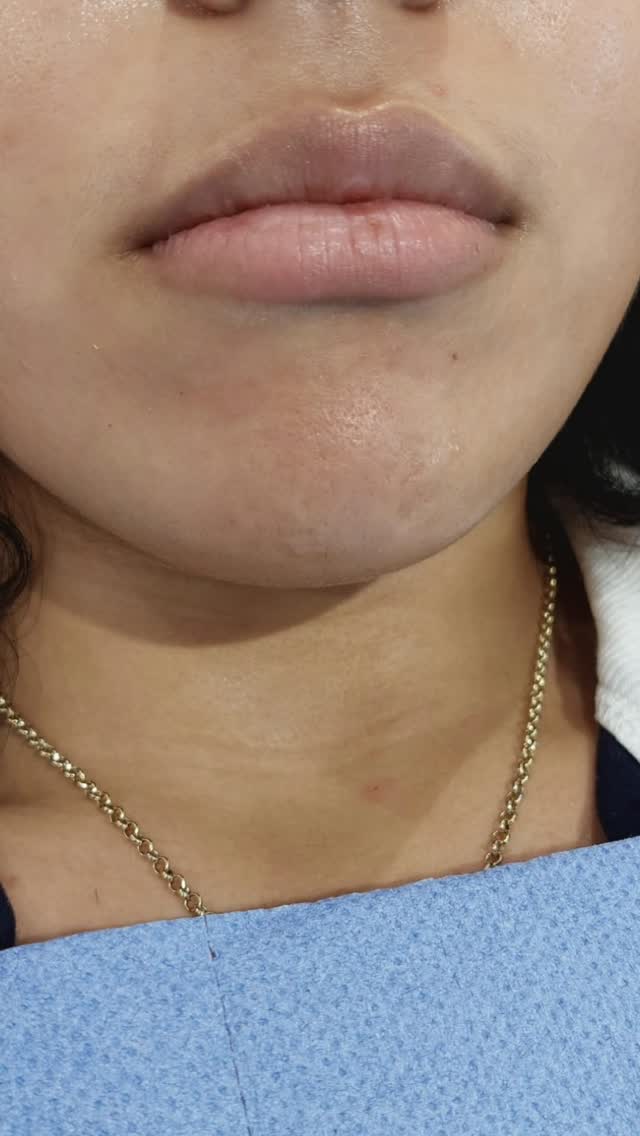 Ready to get that subtle pout? 💋Natural lip filler can seriously up your game, giving you a plump, youthful look without going overboard. Think of it as enhancing your natural beauty, not changing it completely! It's amazing how a little bit of filler can boost your confidence and make your smile pop. Plus, the recovery is usually pretty quick, so you can get back to showing off those gorgeous lips! #LipFiller #bristollipfiller#ConfidenceBoost #bristol #SubtleEnhancement