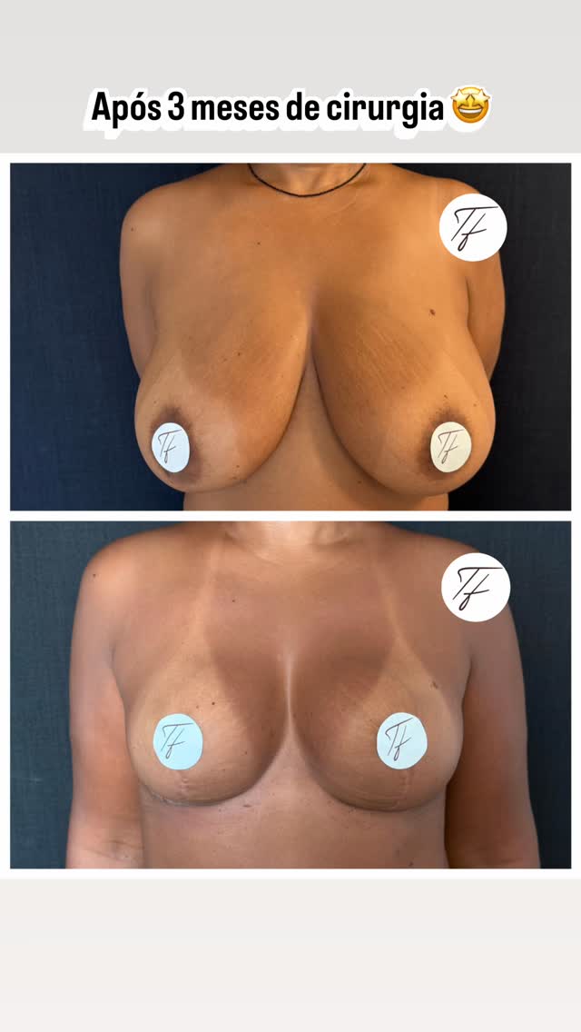 ✨ 3 meses de evolução… e ainda tem mais beleza por vir.
Esse é o momento em que muitas pacientes já conseguem enxergar com clareza a transformação: uma mama mais leve, harmônica, com formato bonito e proporcional ao tórax.
Com 3 meses, grande parte do inchaço já reduziu, a pele começa a se acomodar completamente e o desenho cirúrgico revela cada detalhe pensado desde a marcação.
Mas o mais interessante é lembrar que o resultado ainda segue evoluindo.
A mama tende a ficar ainda mais natural, mais macia e com melhor acomodação do polo inferior nos próximos meses. A cicatriz amadurece, suaviza e o contorno se refina.
Cirurgia de mama é também sobre tempo, biologia e respeito aos tecidos.
Cada fase tem sua beleza — e acompanhar essa evolução é uma das partes mais gratificantes do processo. 🤍
#MamoplastiaRedutora #PosOperatorio #3Meses #CirurgiaMamaria #CicatrizEmL