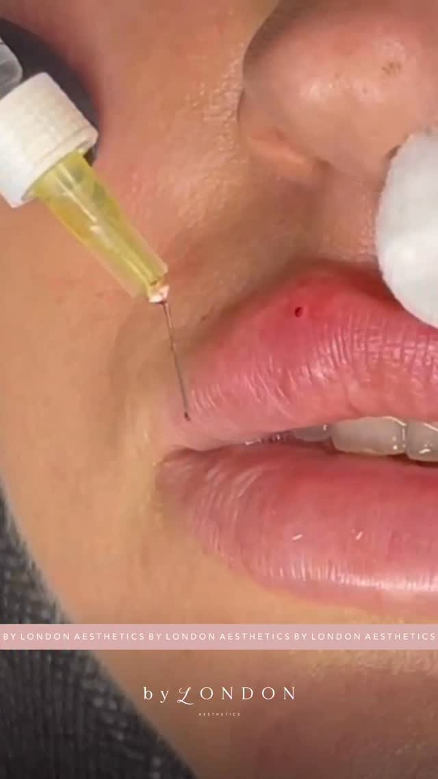 My favourite place….reaching demo model flow state 🤓
𝗕 𝗬 𝗟 𝗢 𝗡 𝗗 𝗢 𝗡 𝗔 𝗘 𝗦 𝗧 𝗛 𝗘 𝗧 𝗜 𝗖 𝗦
📍 High Road, Wood Green, North London
▪️ Russian Lips
▪️ Full Facial Contouring + Balance
▪️ Liquid Rhinoplasty + Pixie Tip Lift
▪️ Skin Boosters, Polynucleotides + Exosomes
▪️ Anti Wrinkle Advanced
▪️ PDO Threads
📃 𝗖𝗣𝗗 𝗔𝗰𝗰𝗿𝗲𝗱𝗶𝘁𝗲𝗱 𝗧𝗿𝗮𝗶𝗻𝗶𝗻𝗴 𝗳𝗼𝗿 𝗔𝗲𝘀𝘁𝗵𝗲𝘁𝗶𝗰 𝗜𝗻𝗷𝗲𝗰𝘁𝗼𝗿𝘀
👩🏻🎓 Pathway & Beginners Packages
🥇 Advanced Level Masterclasses
💻 Online Courses available
📞 WhatsApp Message 07774 054 013
#liftedlips #russianlips #russianlip #russianlipstechnique #russianliptraining