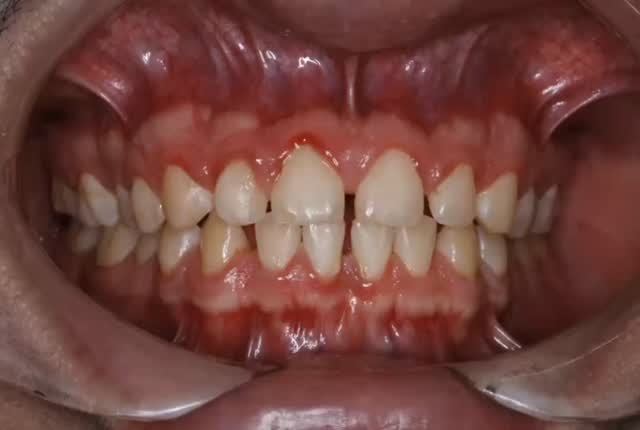 ✨El poder de los alineadores✨
Mi paciente David V tenía espacios entre sus dientes que le molestaban.
Mediante una buena planificación y diagnóstico logramos cerrar estos espacios en poco tiempo, devolviéndole la seguridad y comodidad a David.
Tú también transforma tu sonrisa 🦷👌🏻
.
.
.
.
.
.
UANL Ced. Prof. 12948881
UANL Ced Maestria: 14532598
COFEPRIS: 2419032002A00440
.
.
.
#dentistamty #alineadores
#odontologomty #OrtodonciaMty #espaciosdentales