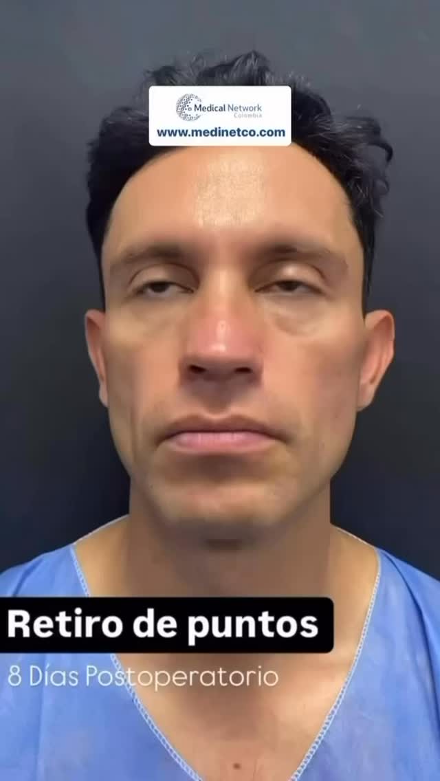 Offrez-vous l’excellence en chirurgie esthétique en Colombie 🇨🇴
✔ Chirurgiens hautement qualifiés
✔ Expérience VIP
✔ Résultats naturels et harmonieux
🎁 Devis gratuit dès aujourd’hui
📩 Contactez-moi en privé sur Messenger
#Rhinoplastie #agenceaandbeauty #surgerycolombia #bogotamedical #bodytransformations