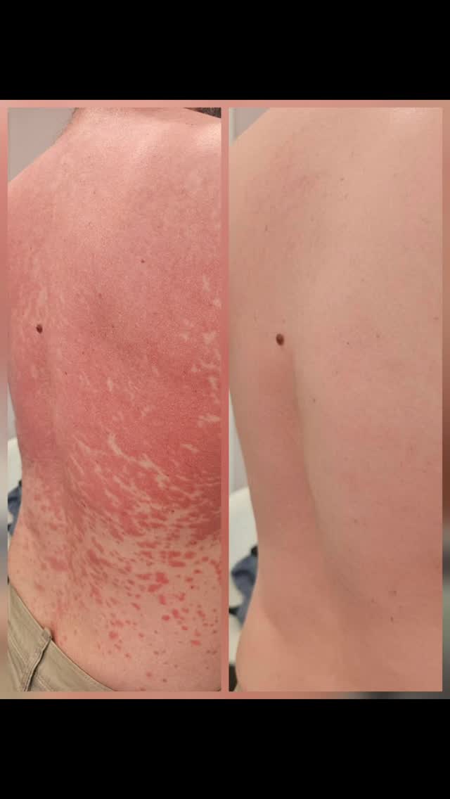 PSORIASIS TREATMENT
This was a deep dive into how he got to this point.
With treating internal and external we were able to get to this point. From not being able to even stand in the shower to his kids saying, "daddy your skin is normal again"
Sometimes flareups come out of nowhere and we have no idea what caused them but when you have the tools they can calm down alot quicker.
Treatment was...
In salon products @liraclinical
LED 4 in salon device
THE MASK homecare device
Internals
#psoriasis #skingoals #skinhealth #ledlights