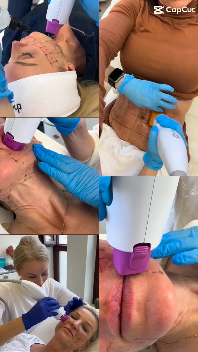 Was, wenn straffere Haut ohne Ausfallzeit möglich wäre?
Thermage arbeitet dort, wo Hautfestigkeit entsteht: in der Tiefe.
Direkt nach der Behandlung kann die Haut bereits straffer und definierter wirken, während sich der Effekt in den Wochen und Monaten danach weiter aufbaut.
Genau das macht die Behandlung so spannend: ein sofort sichtbarer Frische-Kick plus langfristige Kollagenstimulation.
Ideal für alle, die sich ein natürliches Lifting, mehr Kontur und festere Haut wünschen – ohne dass man „gemacht“ aussieht.
Jetzt Termin für deine persönliche Beratung sichern und herausfinden, ob Thermage zu dir und deiner Haut passt.
#thermage #hautstraffung #skinrejuvenation #collagenboost #aestheticmedicine